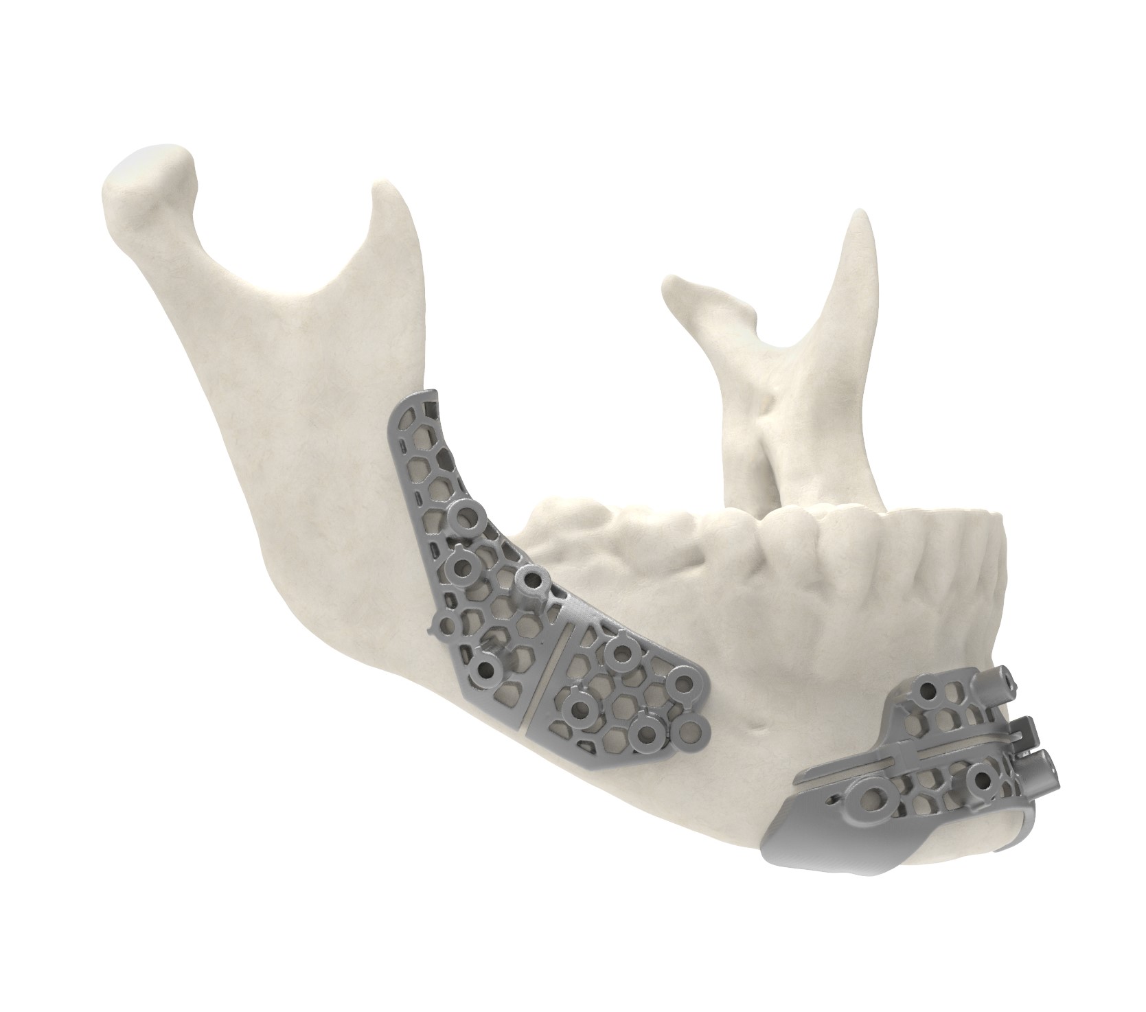 钛合金手术指南。图像通过3D系统。