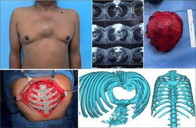 整个胸骨肋骨重建使用3D打印定制钛植入。图片来自Manipal医院。
