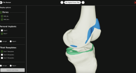 3 d数字膝盖规划。通过3 d图像系统。